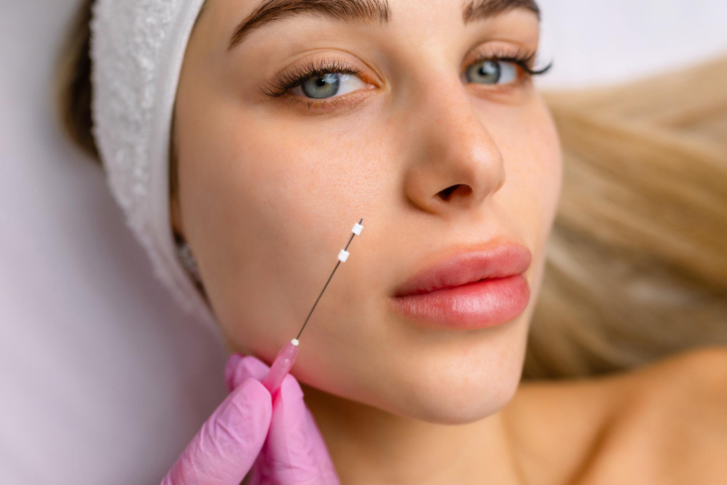 PDO thread lift at Refresh Beauty & Wellness in Glendale, CA