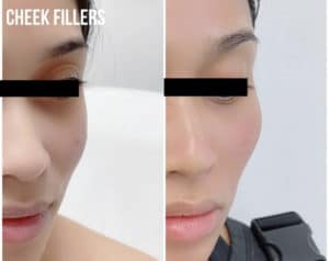 CheekFillerBA-300x238-1
