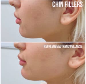 ChinFillerBA-300x294-1