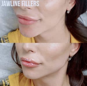 JawlineFillerBA-300x296-1