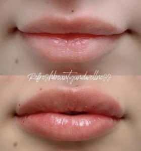 LipFillerBA-279x300-1