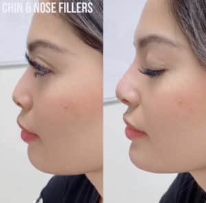 NoseFillerBA-300x296-1