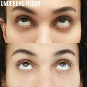 UndereyeFillerBA-300x300-1-300x300